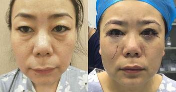 填充泪沟视频,告别憔悴，焕发青春光彩