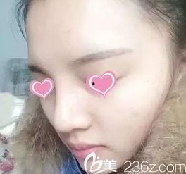 整鼻子手术真实视频,真实视频直击惊心动魄瞬间